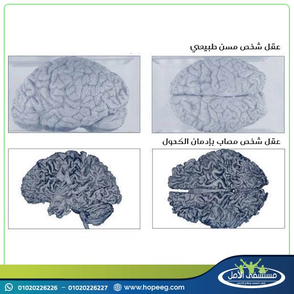 كيف يؤثر استمرار تعاطي المادة المخدرة على المخ؟ 213095316